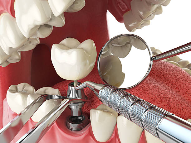 Best Emergency Denture Repair in Frankton, IN